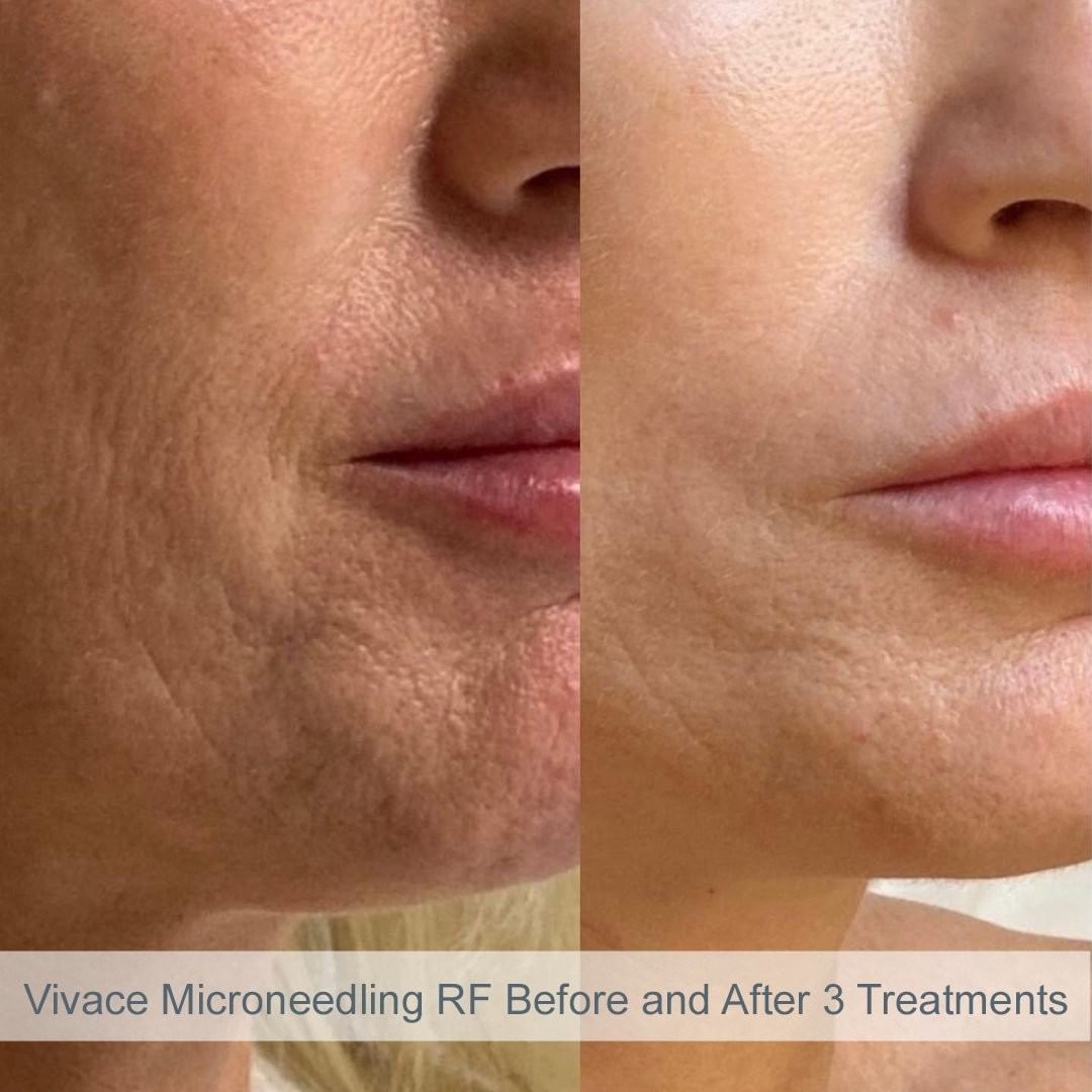 Vivace Microneedling RF Rejuvience Med Spa