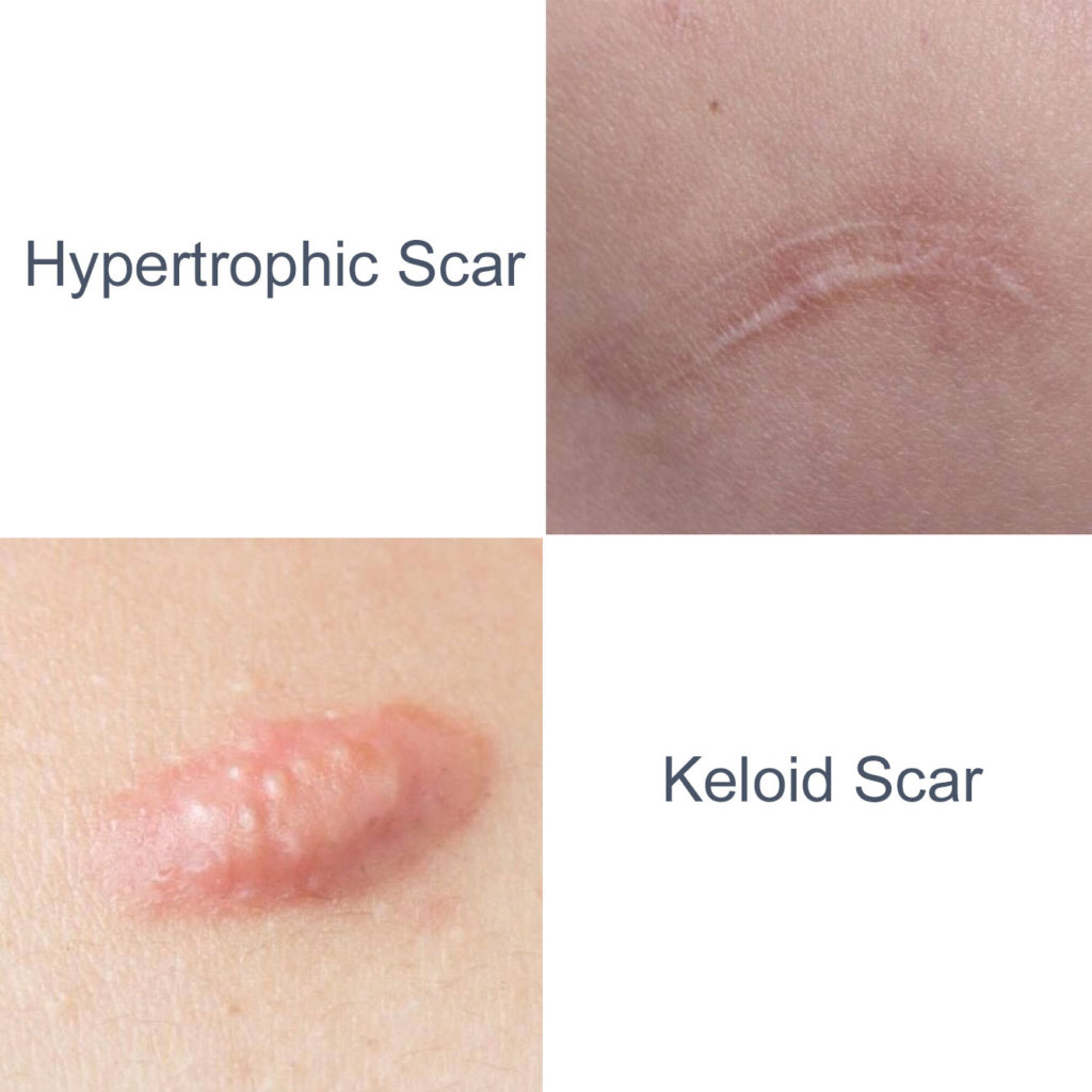 Scar Revision Treatments - Rejuvience Med Spa