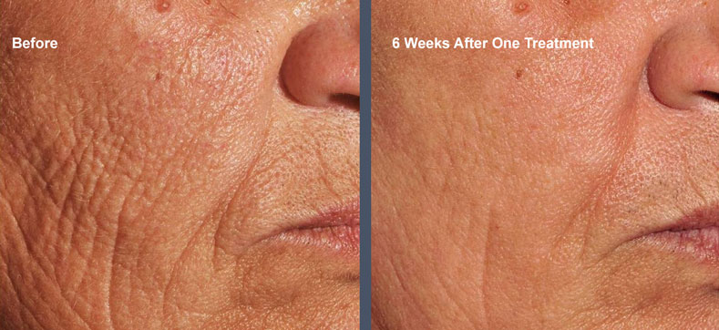 Venus Viva Wrinkles Before and After