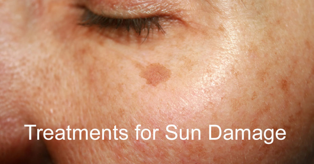 Sun Damage Treatments Rejuvience Med Spa Phoenix Scottsdale