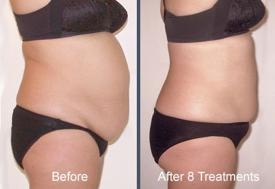 What is the difference between body contouring and liposuction? - Celebrity  Laser & Skin Care