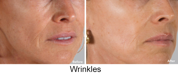 AnteAge B&A Wrinkles