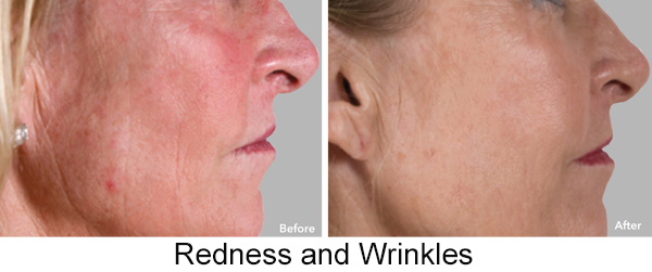 AnteAge MD Wrinkles & Redness