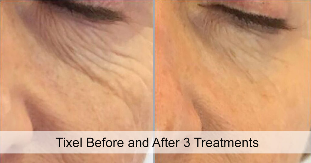 Tixel Skin Resurfacing Scottsdale