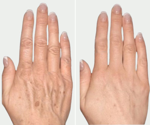 Hand Rejuvenation LaseMD at Rejuvience Med Spa