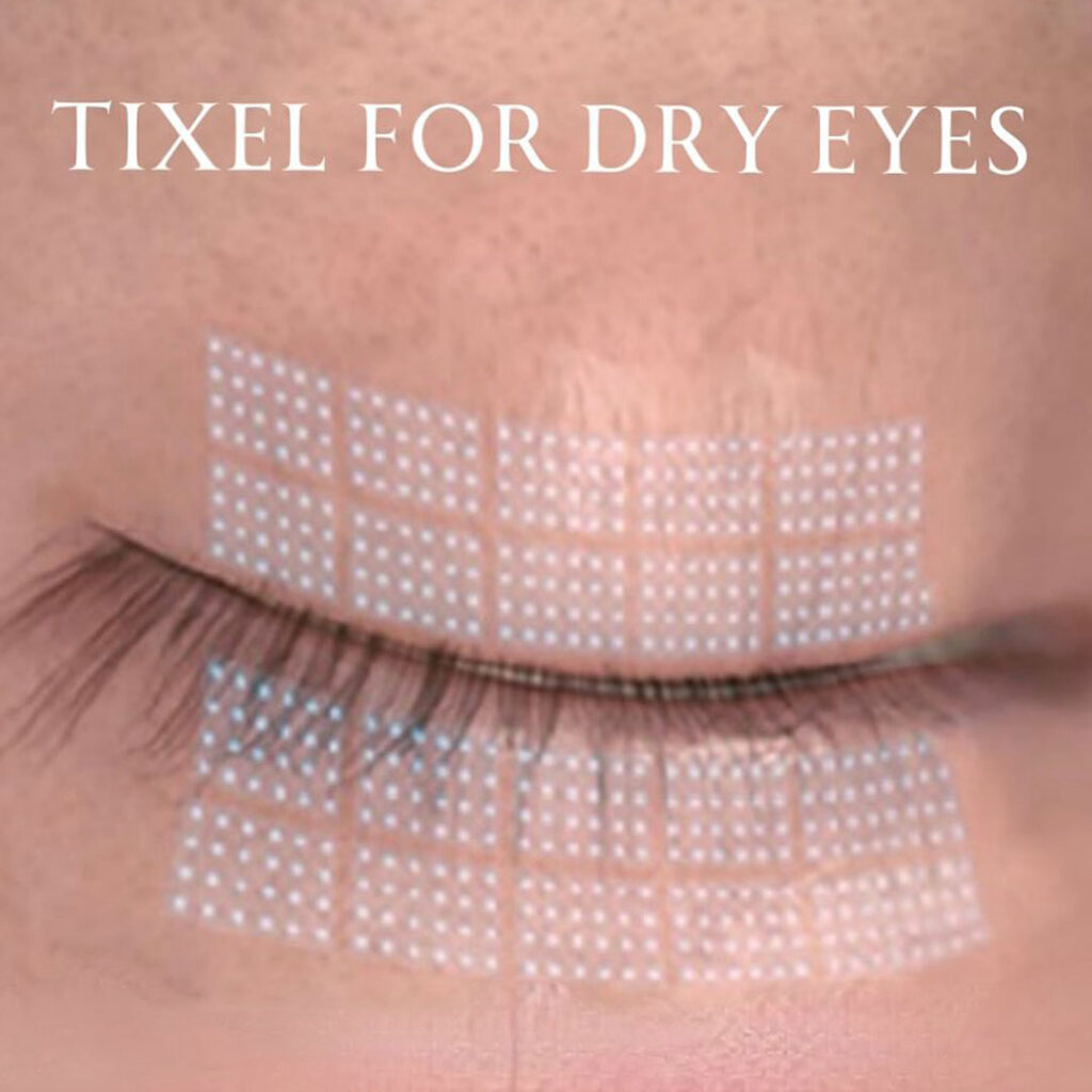 Scottsdale Tixel Treatment Eye Lift