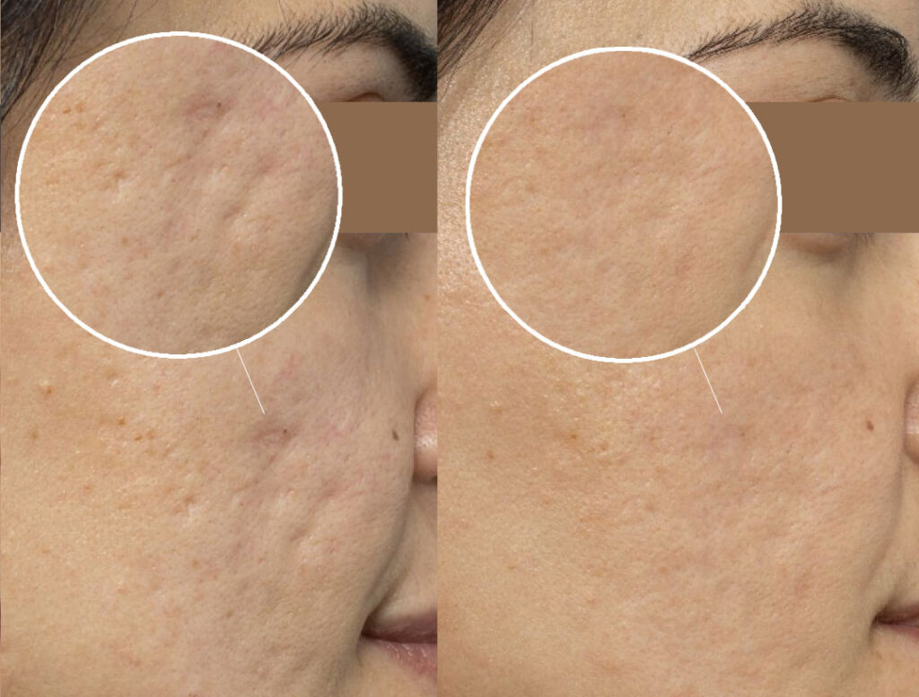 Microneedling Acne Scottdale at Rejuvience Med Spa Before & After