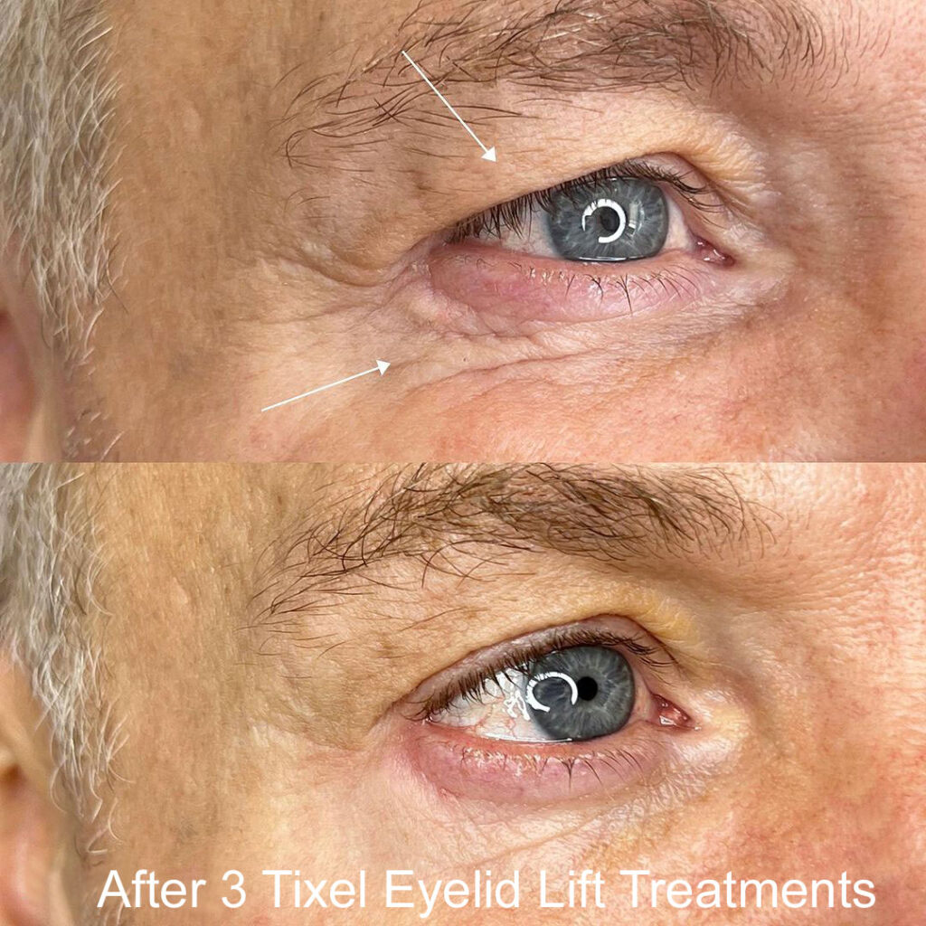 Tixel EyeLid Lift Treatment Scottsdale Before & After