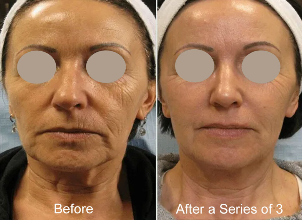 Tixel Treatment Scottsdale Before & After