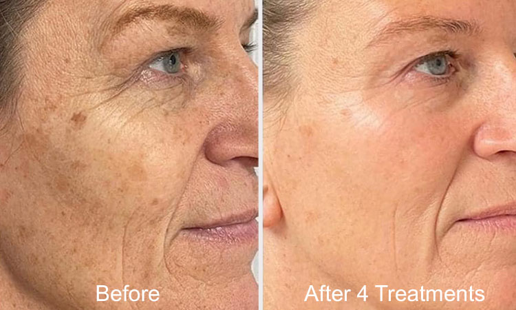 Age Spot Treatment Rejuvience Med Spa Scottsdale