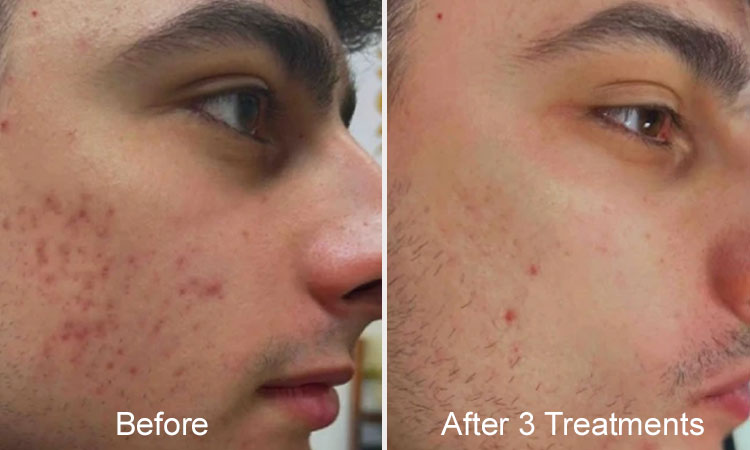 Hyperpigmentation Treatment Rejuvience Med Spa Scottsdale