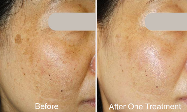 Melasma Treatment Rejuvience Med Spa Scottsdale