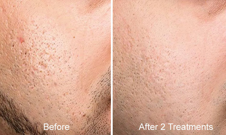 Microneedling Before After Rejuvience Med Spa Acne Scar