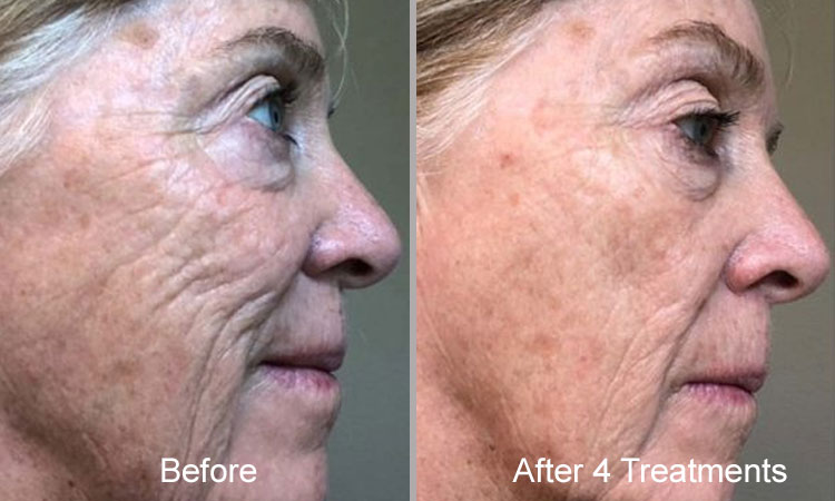 Microneedling Before After Rejuvience Med Spa Glycated