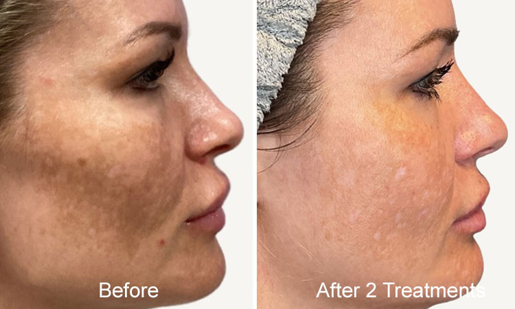 Microneedling Before After Rejuvience Med Spa Melasma