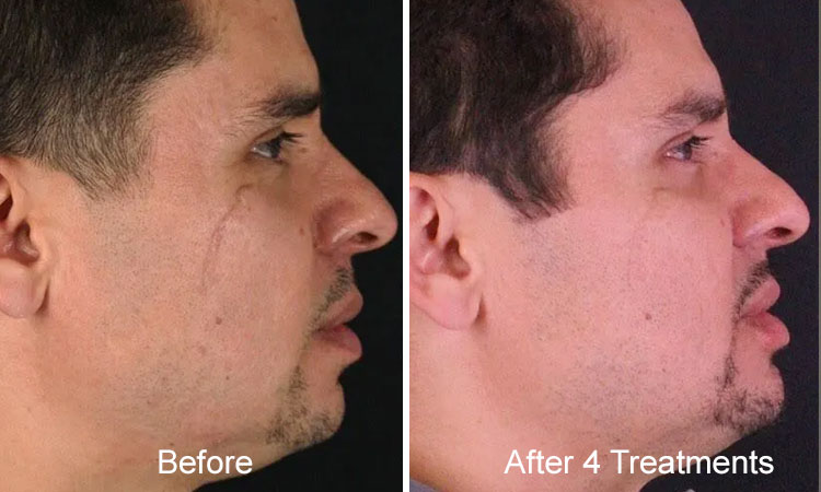 Microneedling Before After Rejuvience Med Spa Scar