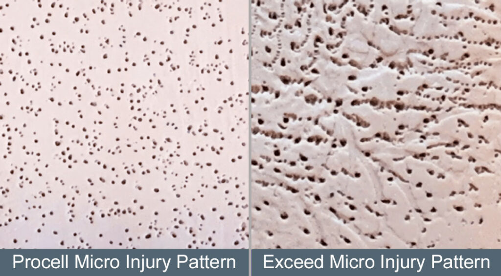 Procell vs Exceed Micro Injury Pattern