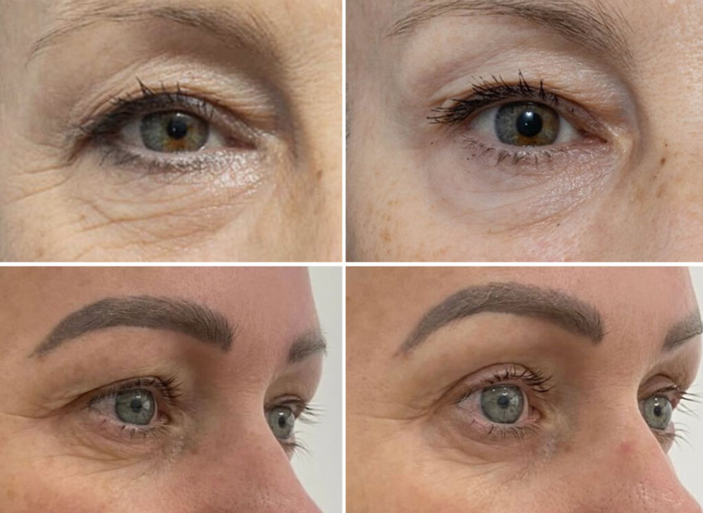 Tixel Eyelid Lift