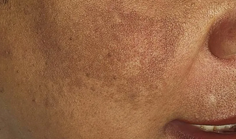 melasma skin