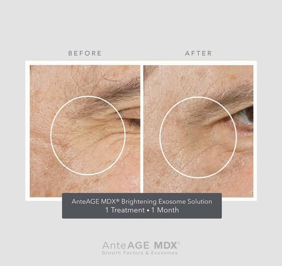 AnteAGE MDX Exosome Brightening Solution B&A 1