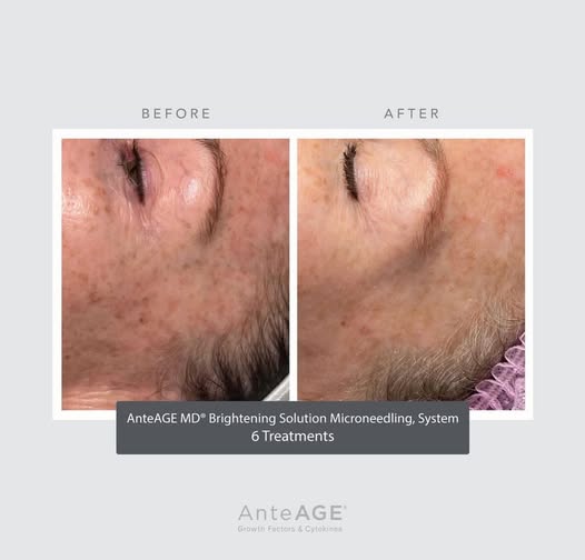 AnteAGE MDX Exosome Brightening Solution B&A 2