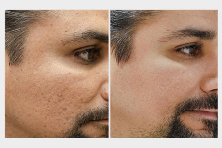 Before and after images of a man with acne scars who received an acne scar treatment at Rejuvience Med Spa in Scottsdale, Arizona.