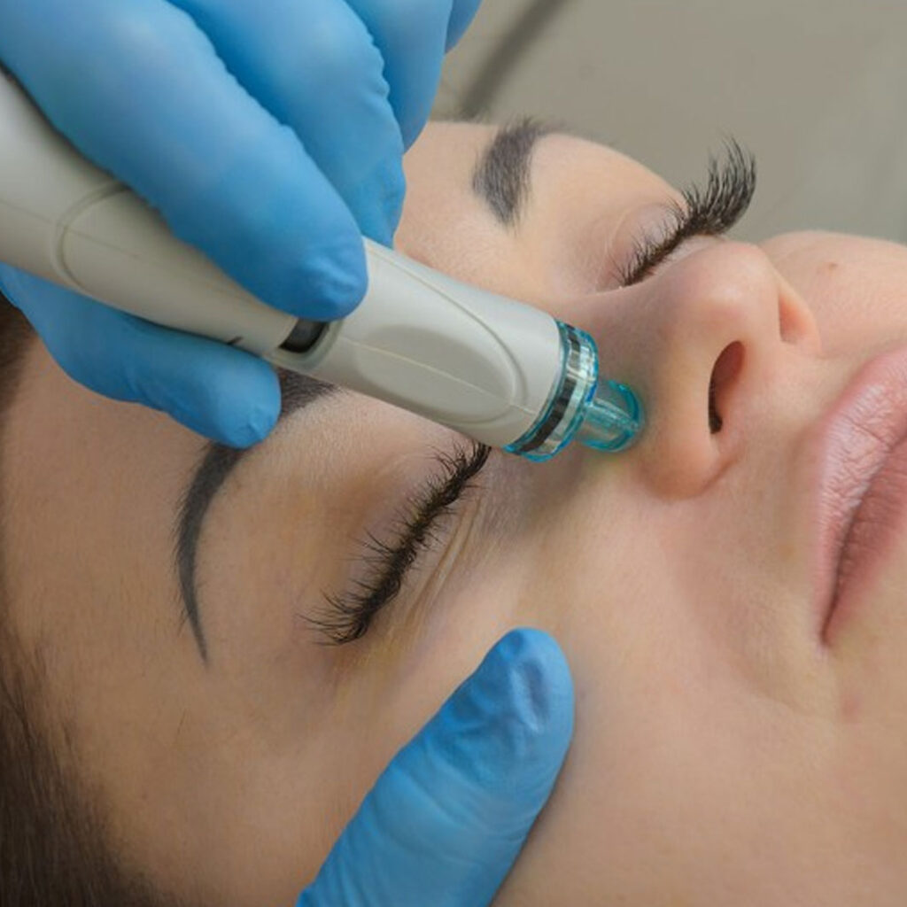 An image of a womean getting a hydrodermabrasion treatment at Rejuvience Med Spa in Scottsdale