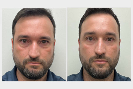 Before and after images of a man treated for eyelid hooding and under eye darkness who received a skin rejuvenation treatment for wrinkles at Rejuvience Med Spa in Scottsdale, Arizona.