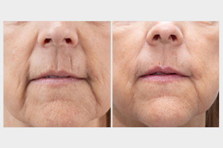 Before and after images of an older woman who received a skin rejuvenation treatment for wrinkles at Rejuvience Med Spa in Scottsdale, Arizona.