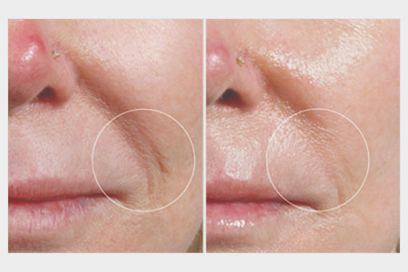 Before and after images of a woman with deep nasial labial fold wrinkles who received a skin rejuvenation treatment for wrinkles at Rejuvience Med Spa in Scottsdale, Arizona.