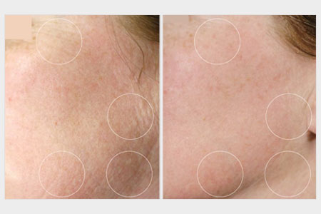 Before and after images of a woman following treatment for rosacea who received a skin rejuvenation treatment for wrinkles at Rejuvience Med Spa in Scottsdale, Arizona.