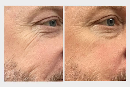 Before and after images of a man treated for wrinkles who received a skin rejuvenation treatment for wrinkles at Rejuvience Med Spa in Scottsdale, Arizona.