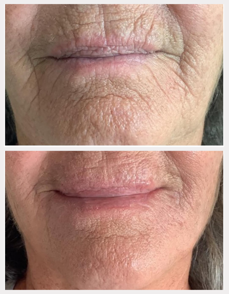 Images of lip lines before and after treatment at Rejuvience Med Spa in Scottsdale