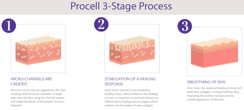 An image of the three stages of Procell Microchanneling healing